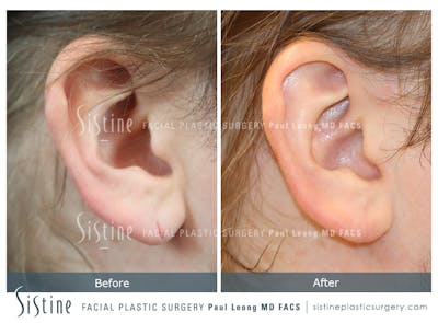 Earlobe Repair Before & After Gallery - Patient 107041 - Image 1