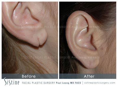 Earlobe Repair Before & After Gallery - Patient 366536 - Image 1