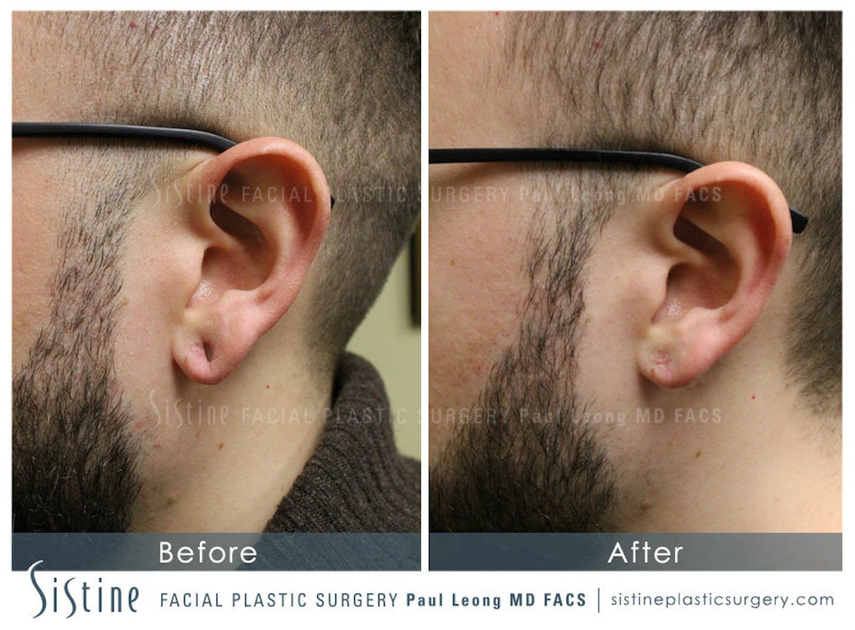 Earlobe Repair Before & After Gallery - Patient 299472 - Image 1