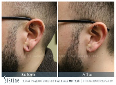 Earlobe Repair Before & After Gallery - Patient 299472 - Image 1