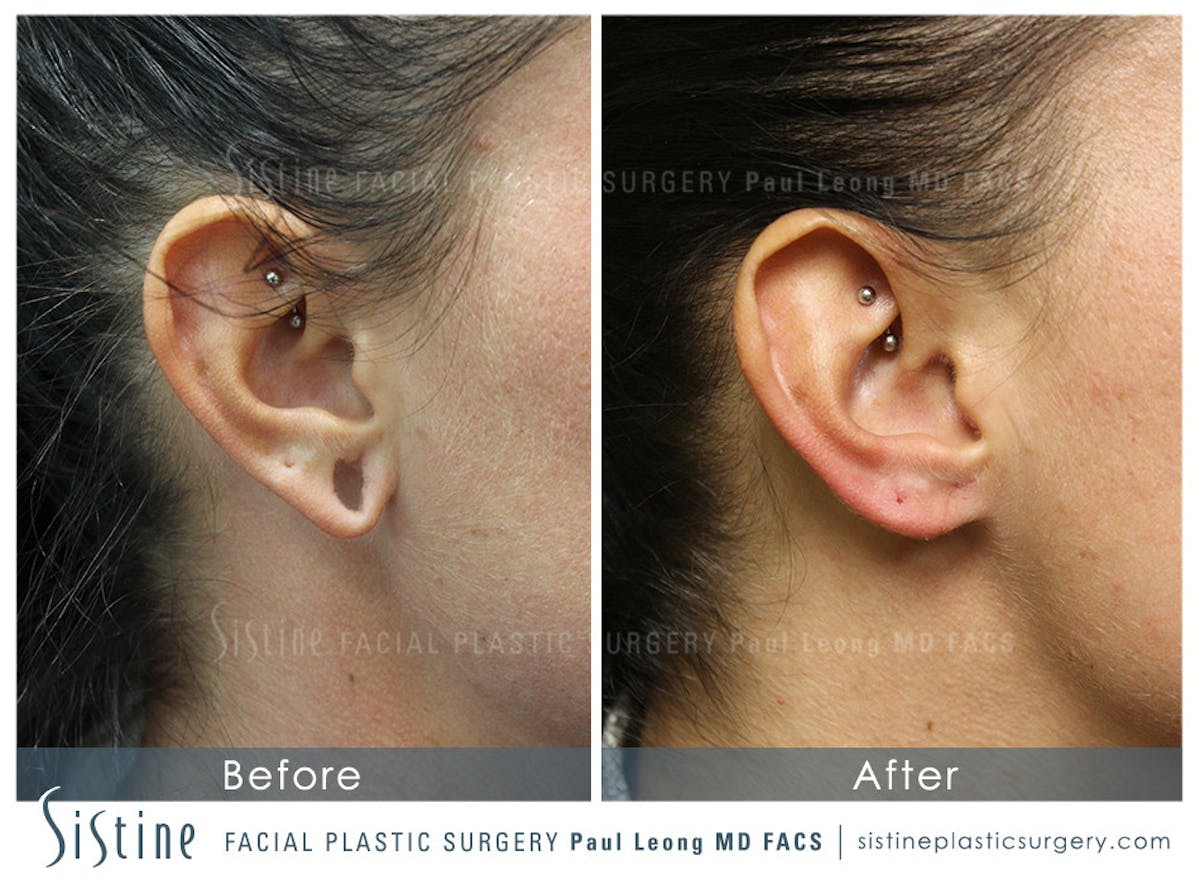 Ears Before & After Gallery - Patient 319645 - Image 1