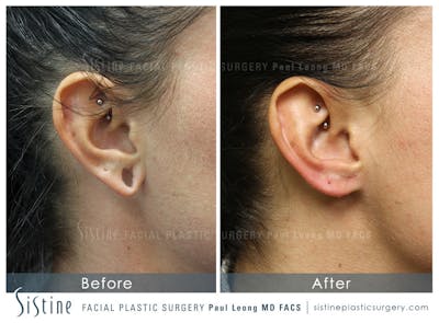 Earlobe Repair Before & After Gallery - Patient 174732 - Image 1