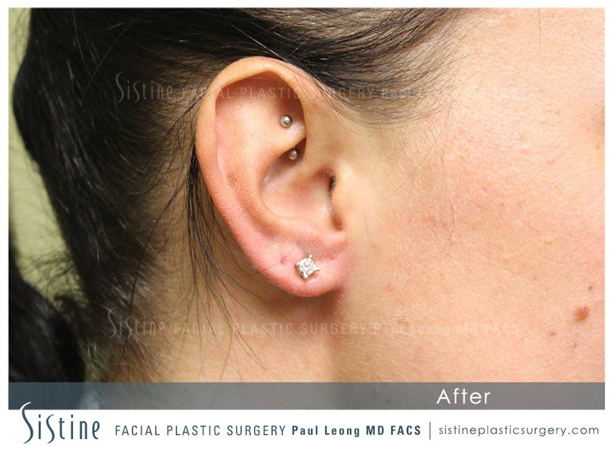 Ears Before & After Gallery - Patient 319645 - Image 2