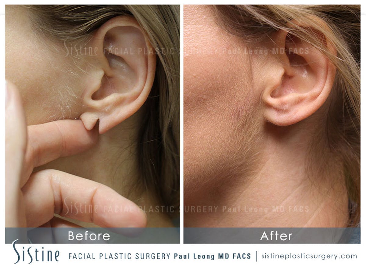 Ears Before & After Gallery - Patient 215338 - Image 1