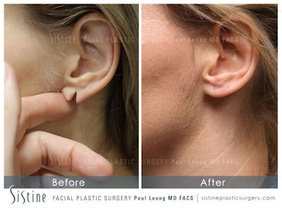 Earlobe Repair Before & After Gallery - Patient 148436 - Image 1