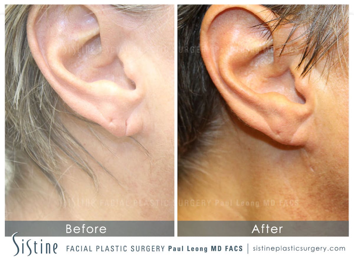 Ears Before & After Gallery - Patient 833689 - Image 1