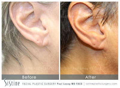 Earlobe Repair Before & After Gallery - Patient 230889 - Image 1