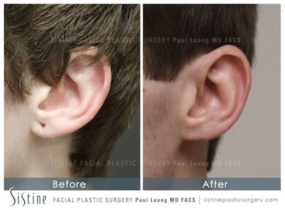Earlobe Repair Before & After Gallery - Patient 337010 - Image 1