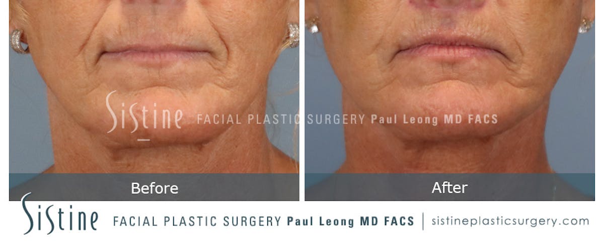 Lip Lift Before & After Gallery - Patient 214822 - Image 1