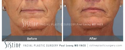 Lip Lift Before & After Gallery - Patient 214822 - Image 1