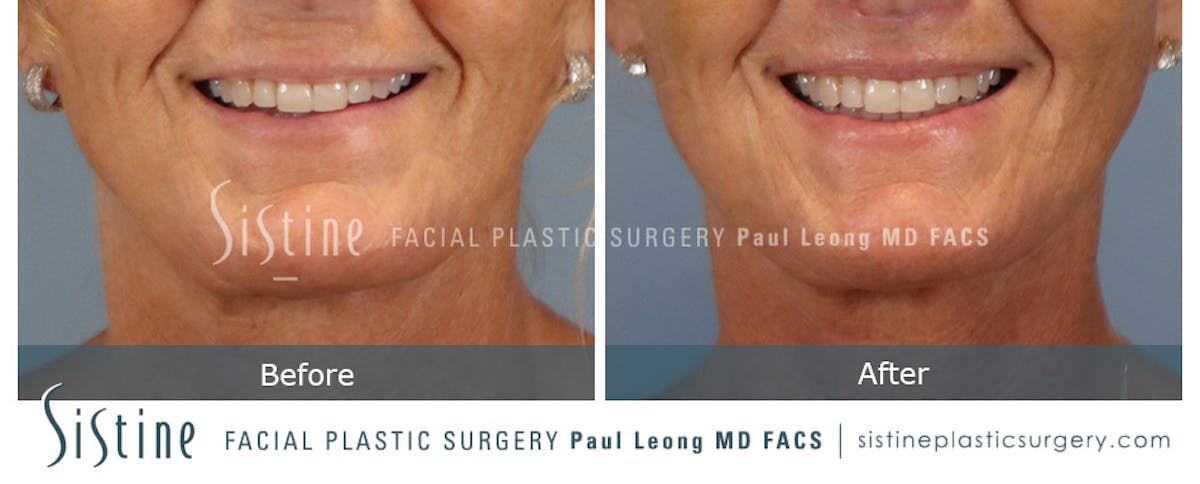 Lip Lift Before & After Gallery - Patient 214822 - Image 2
