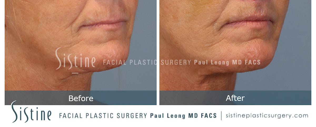 Lip Lift Before & After Gallery - Patient 214822 - Image 3