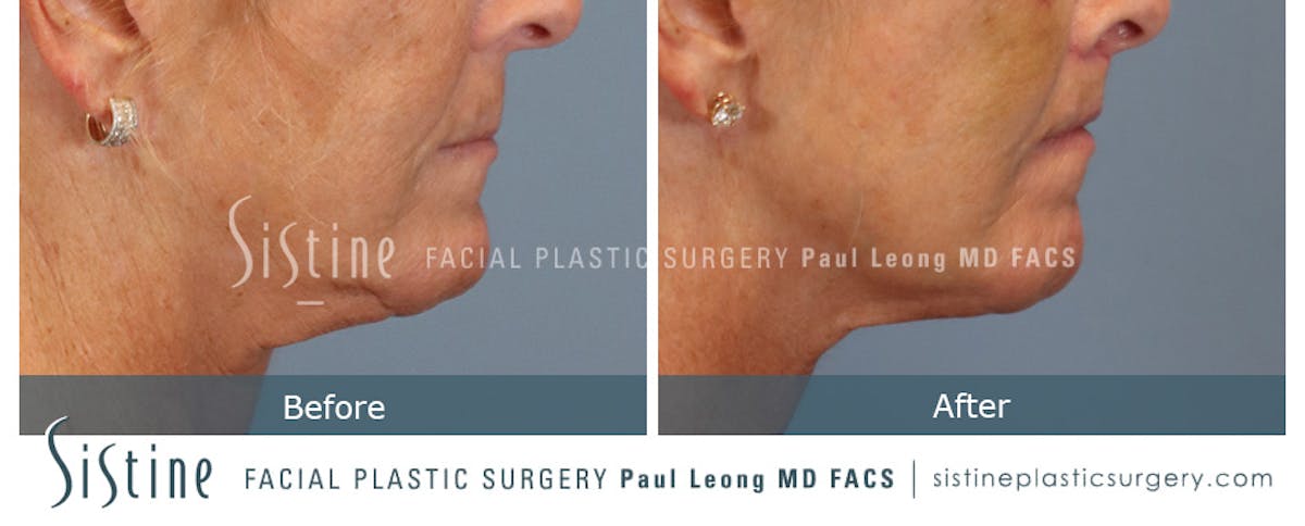 Lip Lift Before & After Gallery - Patient 214822 - Image 4