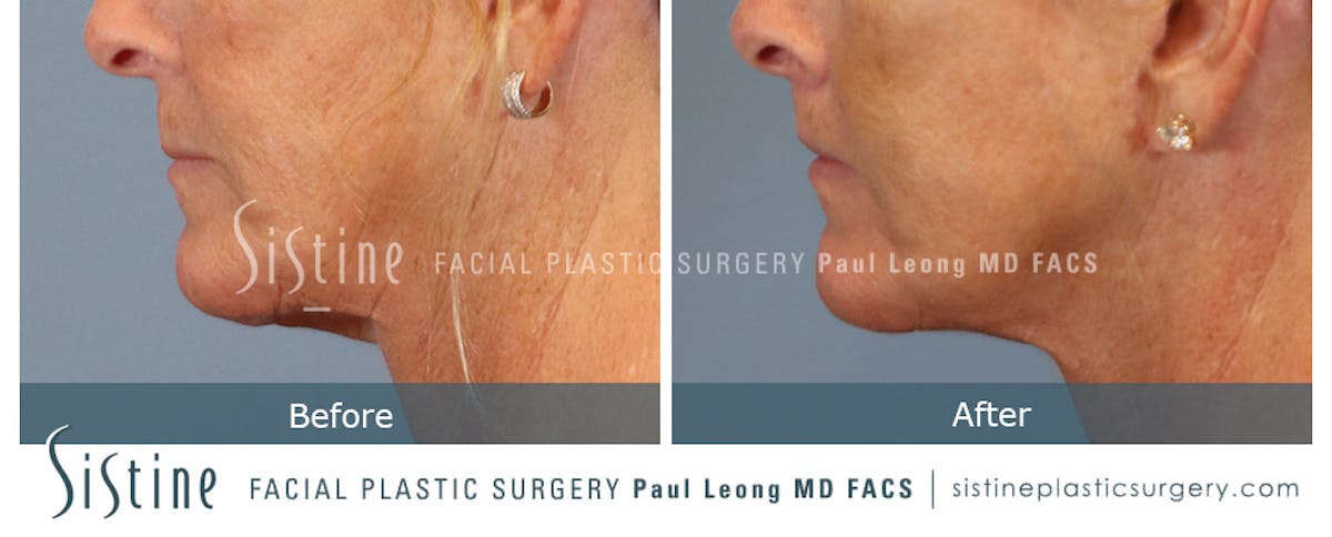Lip Lift Before & After Gallery - Patient 214822 - Image 6