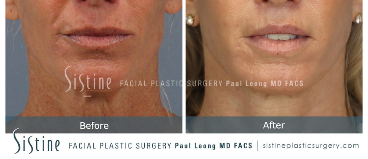 Lip Lift Before & After Gallery - Patient 922531 - Image 1