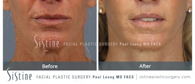 Lip Lift Before & After Gallery - Patient 922531 - Image 1