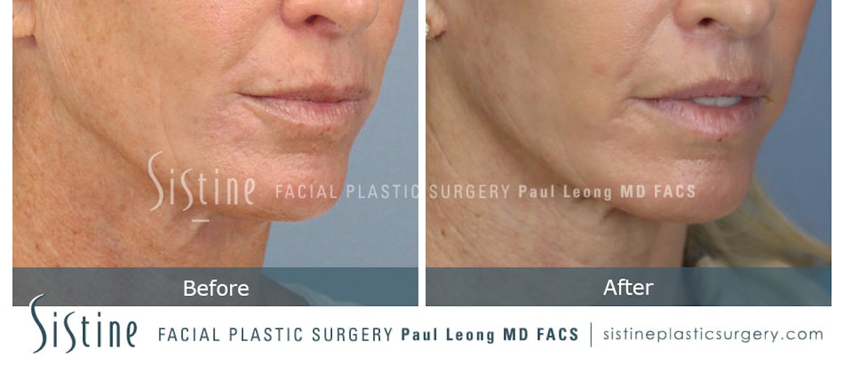 Lip Lift Before & After Gallery - Patient 922531 - Image 3