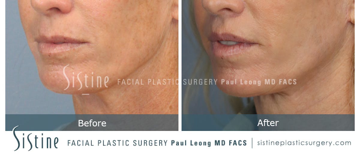 Lip Lift Before & After Gallery - Patient 922531 - Image 4