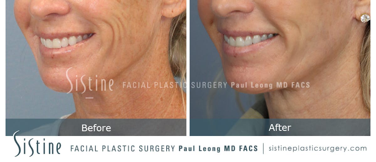 Lip Lift Before & After Gallery - Patient 922531 - Image 5