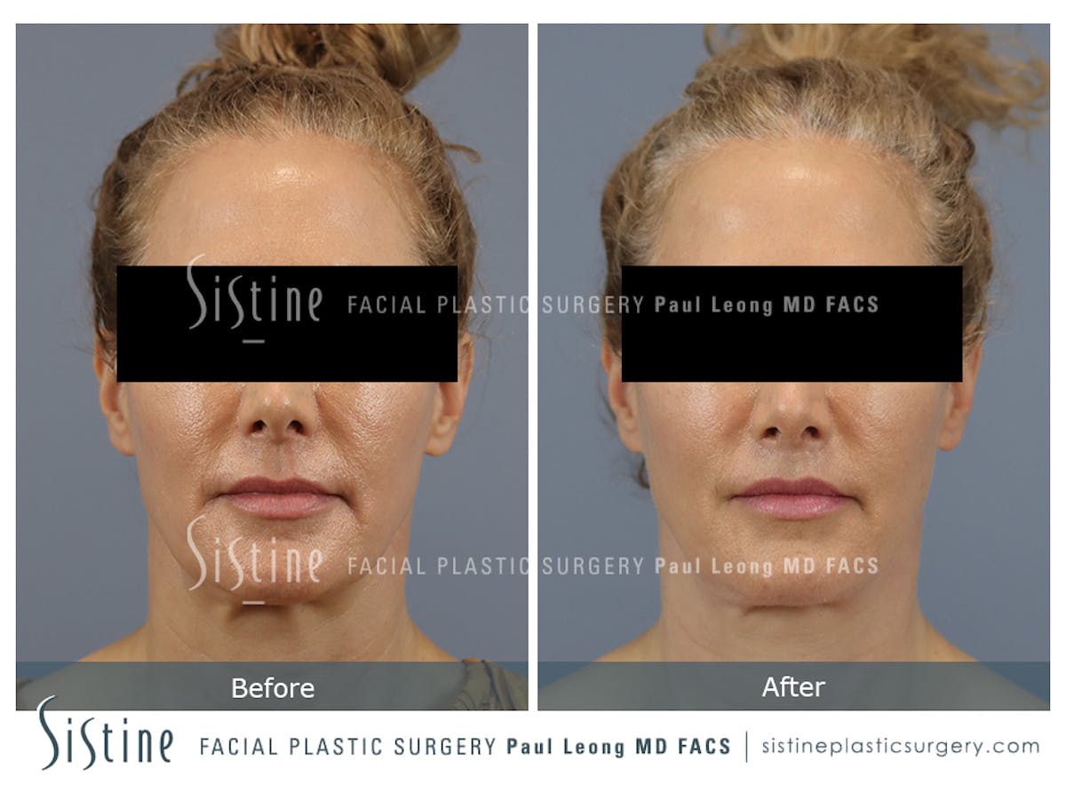 Lip Lift Before & After Gallery - Patient 135443 - Image 1