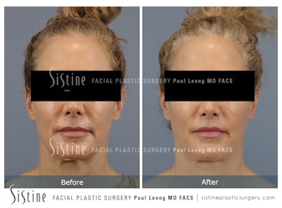 Lip Lift Before & After Gallery - Patient 135443 - Image 1
