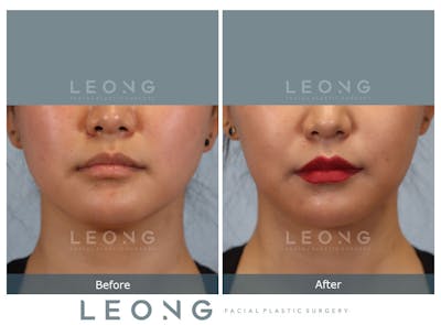 Buccal Fat Removal Before & After Gallery - Patient 150911 - Image 1