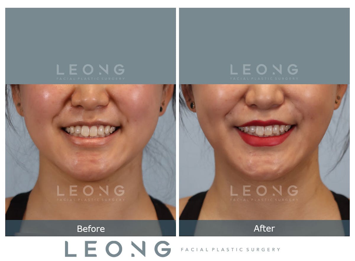 Buccal Fat Removal Before & After Gallery - Patient 150911 - Image 2