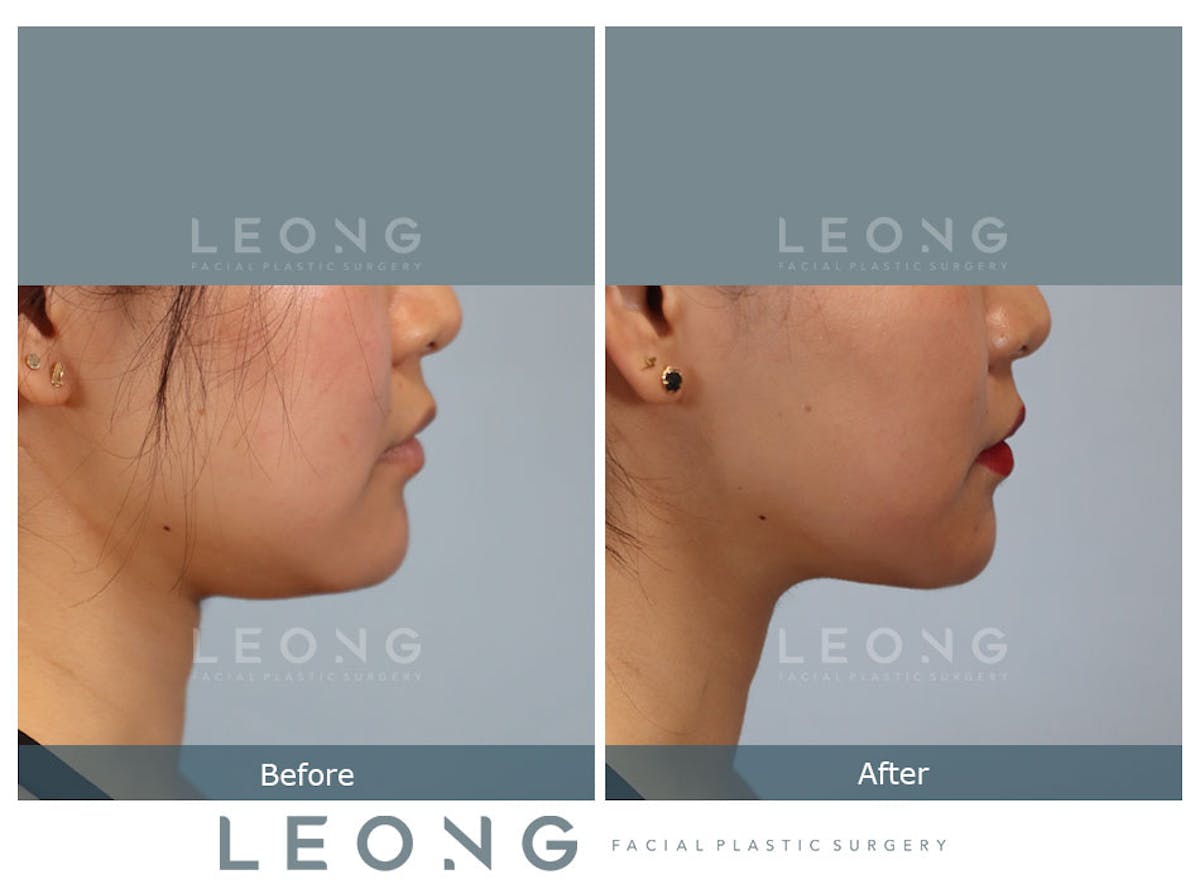 Buccal Fat Removal Before & After Gallery - Patient 150911 - Image 3