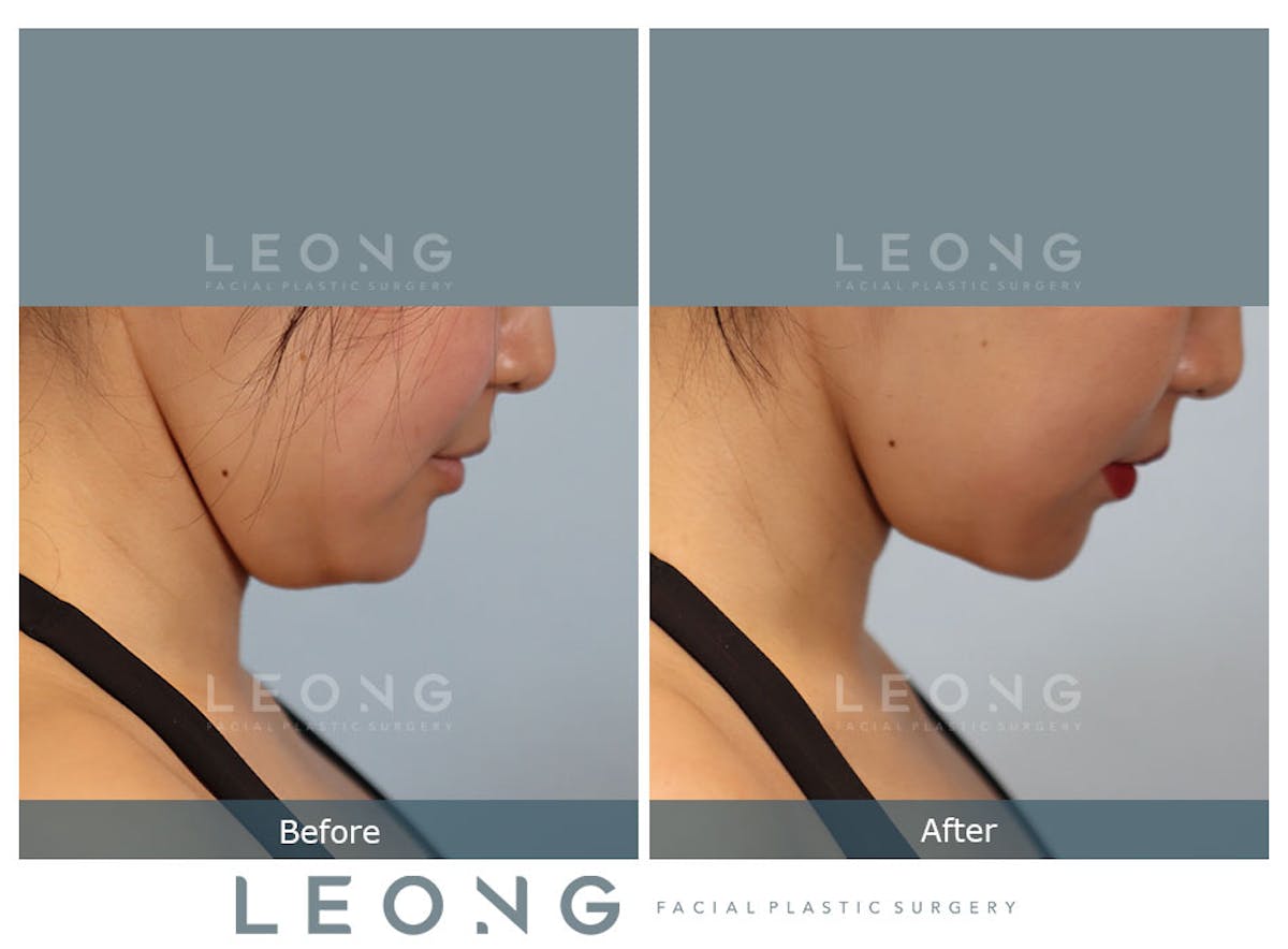 Buccal Fat Removal Before & After Gallery - Patient 150911 - Image 4