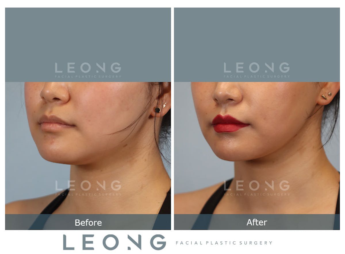 Buccal Fat Removal Before & After Gallery - Patient 150911 - Image 5