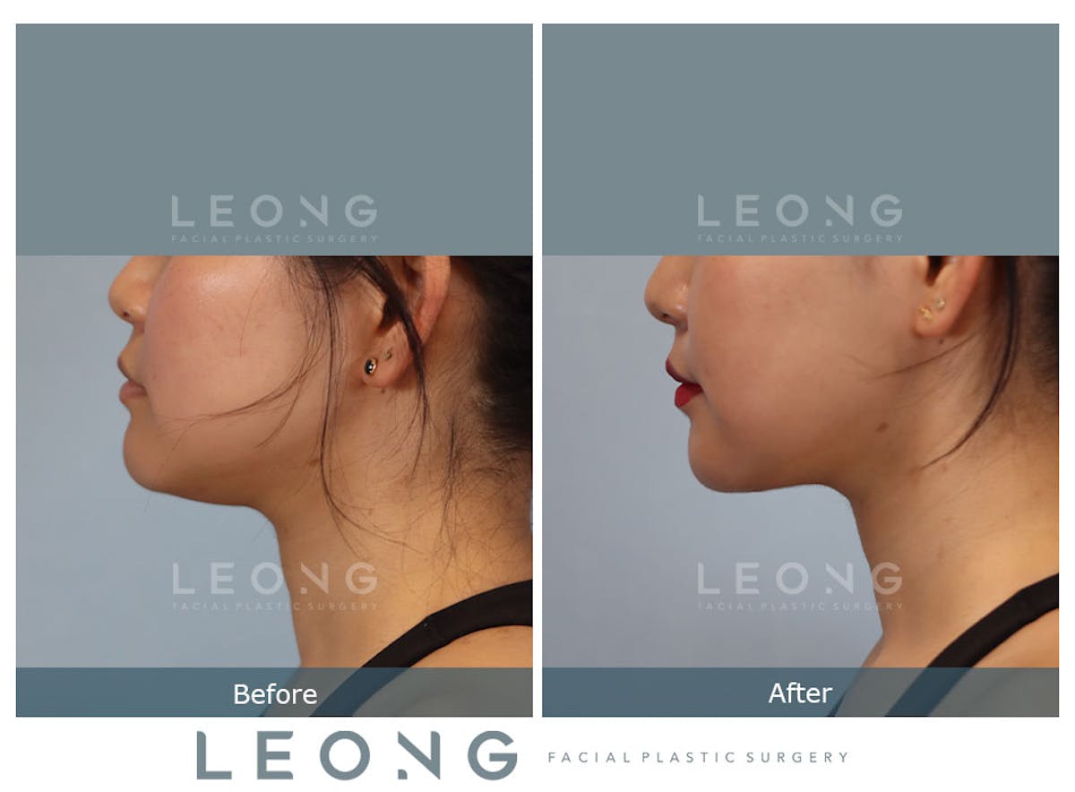 Buccal Fat Removal Before & After Gallery - Patient 150911 - Image 6