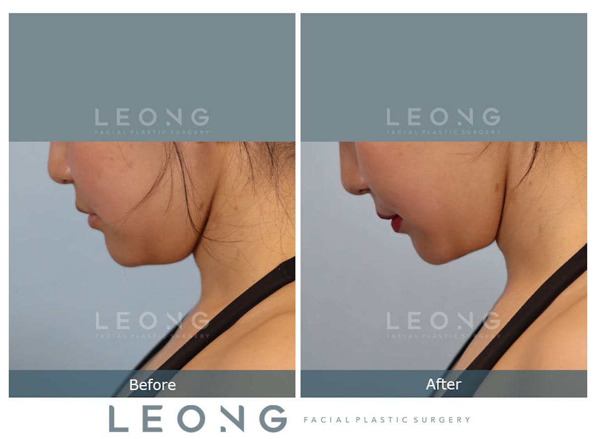 Buccal Fat Removal Before & After Gallery - Patient 150911 - Image 7