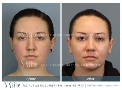 Buccal Fat Removal Before & After Gallery - Patient 112302 - Image 1