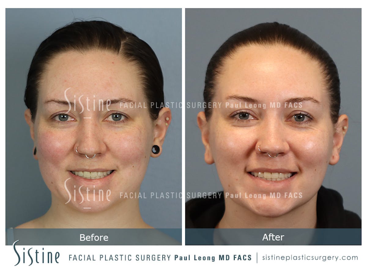 Buccal Fat Removal Before & After Gallery - Patient 112302 - Image 2
