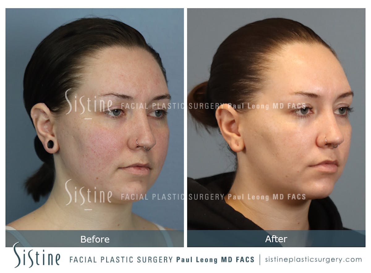 Buccal Fat Removal Before & After Gallery - Patient 112302 - Image 3