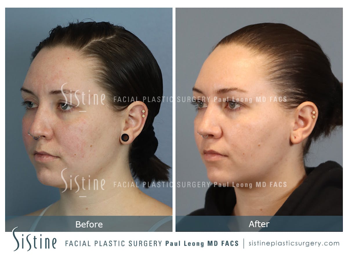 Buccal Fat Removal Before & After Gallery - Patient 112302 - Image 4