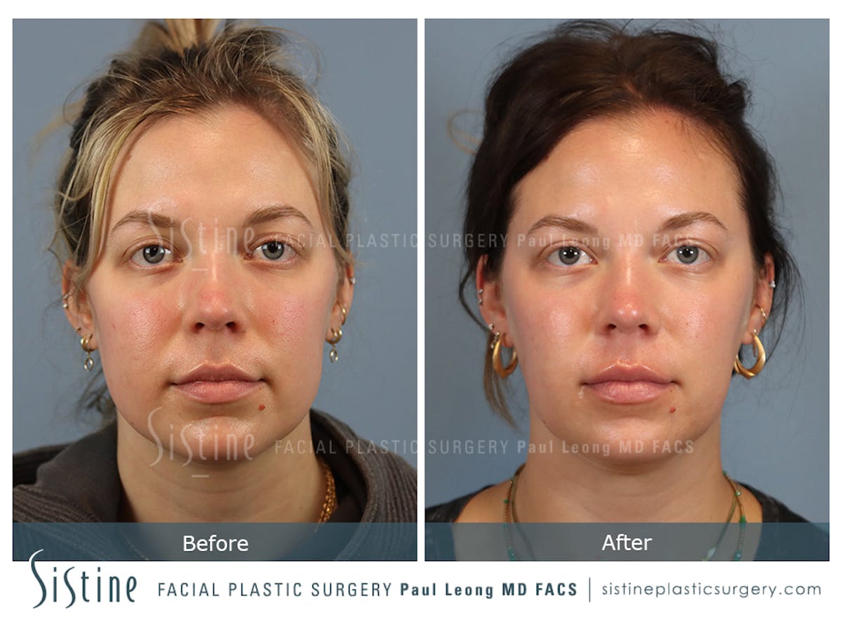 Buccal Fat Removal Before & After Gallery - Patient 182616 - Image 1