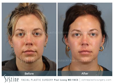 Buccal Fat Removal Before & After Gallery - Patient 182616 - Image 1