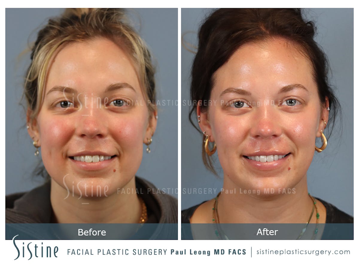 Buccal Fat Removal Before & After Gallery - Patient 182616 - Image 2