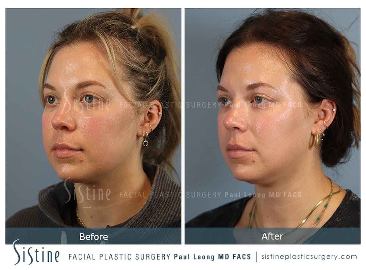 Buccal Fat Removal Before & After Gallery - Patient 182616 - Image 3