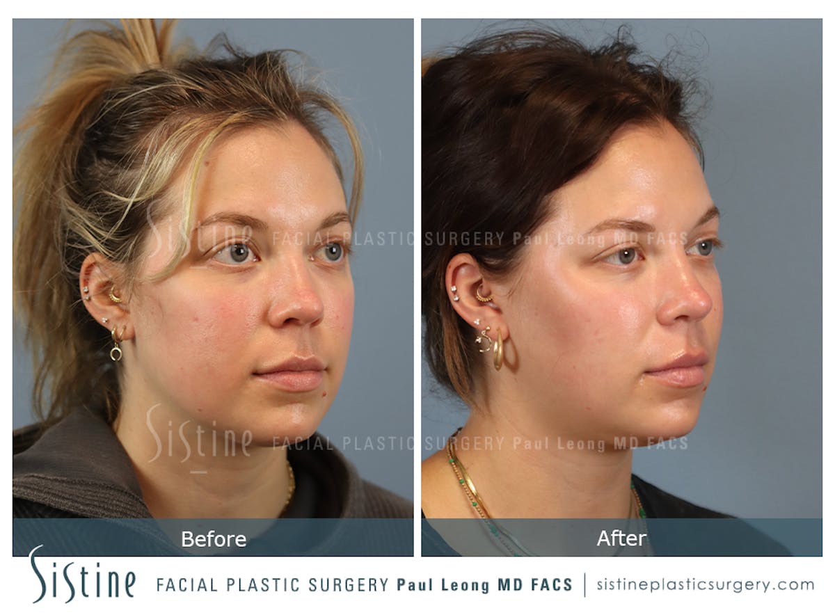 Buccal Fat Removal Before & After Gallery - Patient 182616 - Image 4
