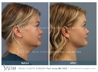 Deep Neck Lift Before & After Gallery - Patient 118546 - Image 1