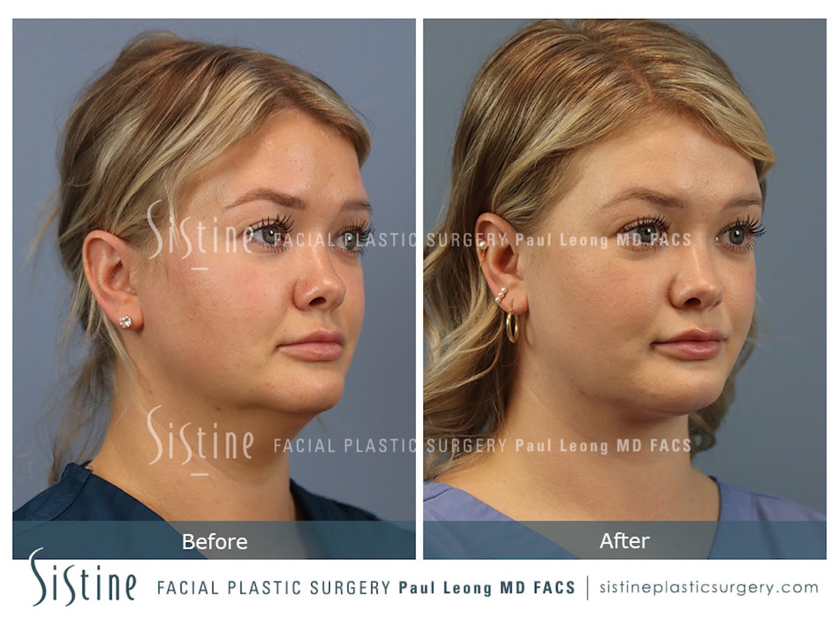 Deep Neck Lift Before & After Gallery - Patient 118546 - Image 2