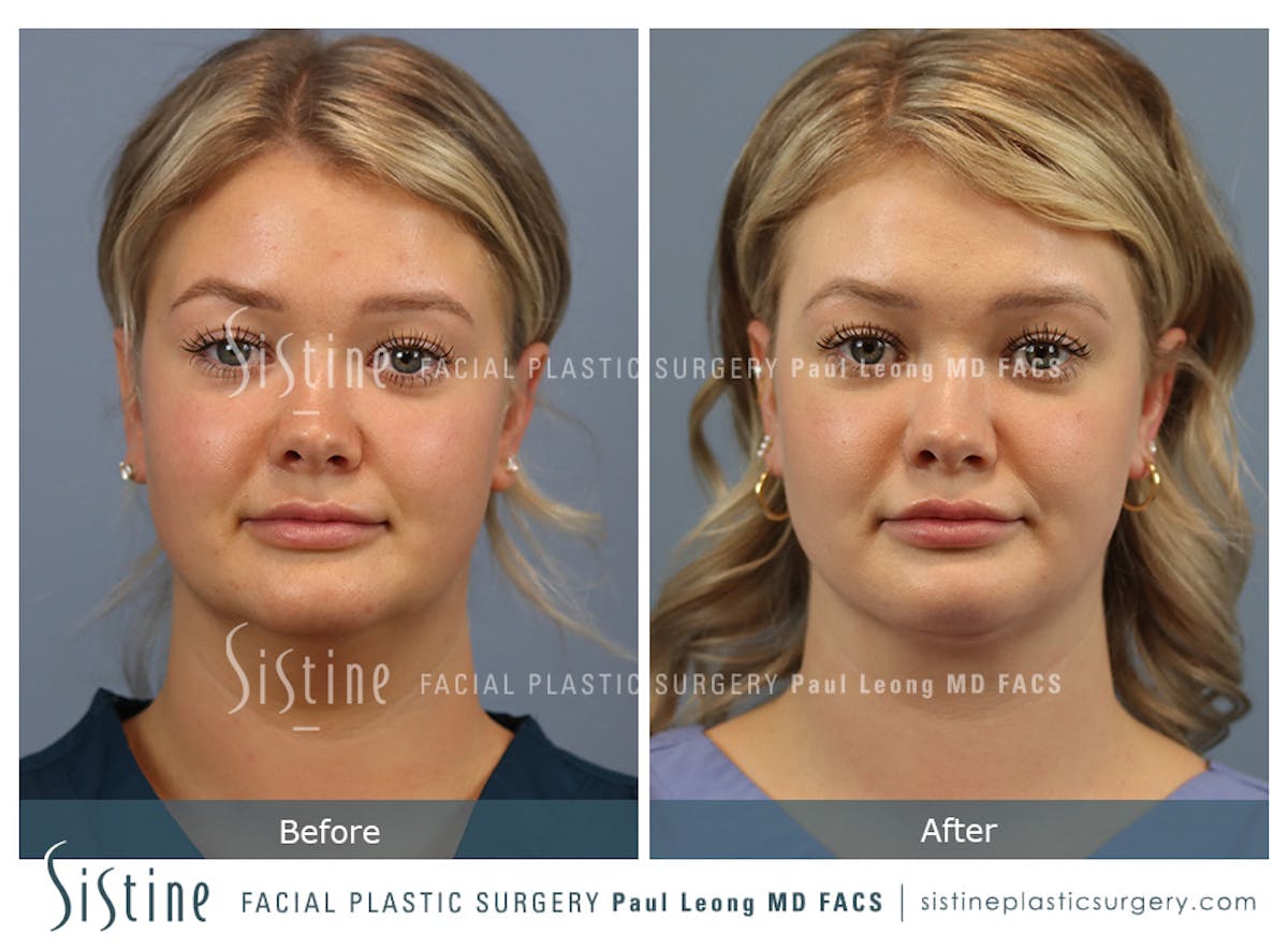 Deep Neck Lift Before & After Gallery - Patient 118546 - Image 3