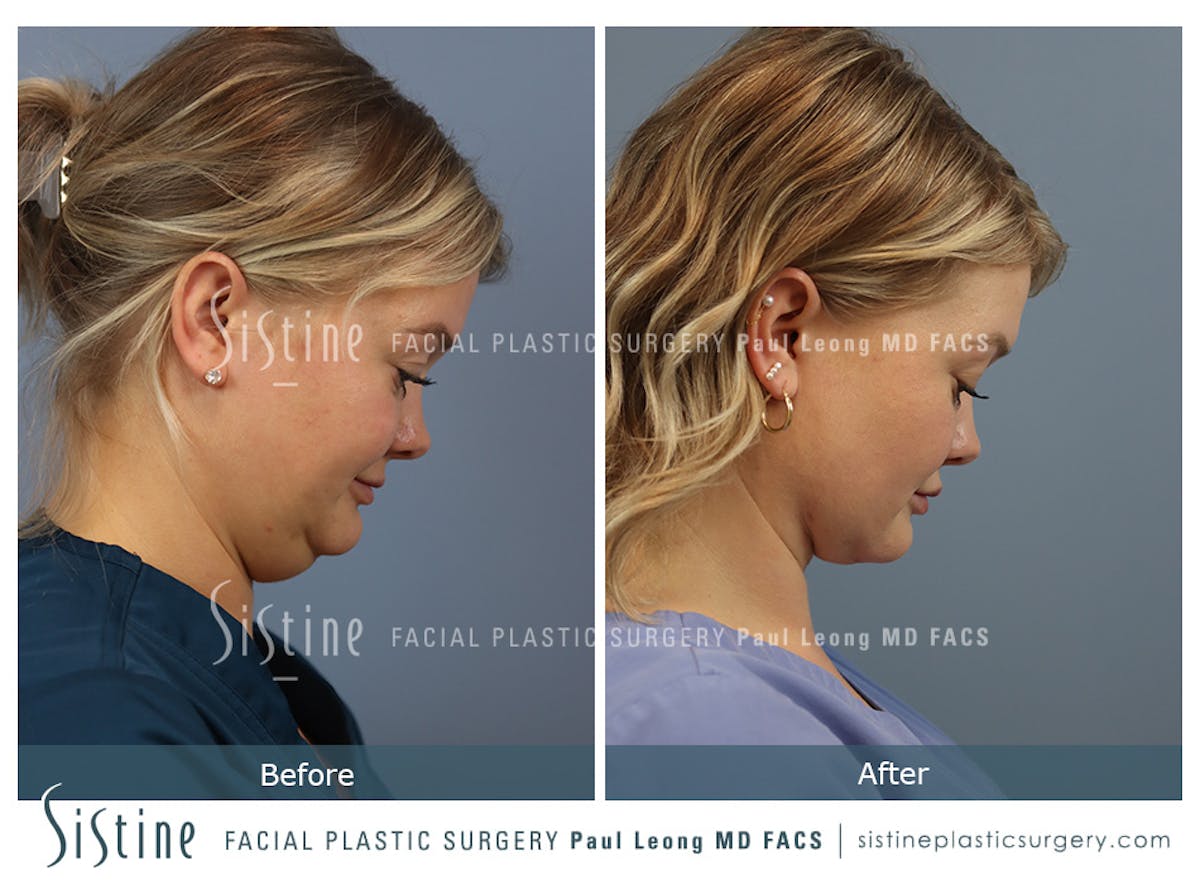 Deep Neck Lift Before & After Gallery - Patient 118546 - Image 4