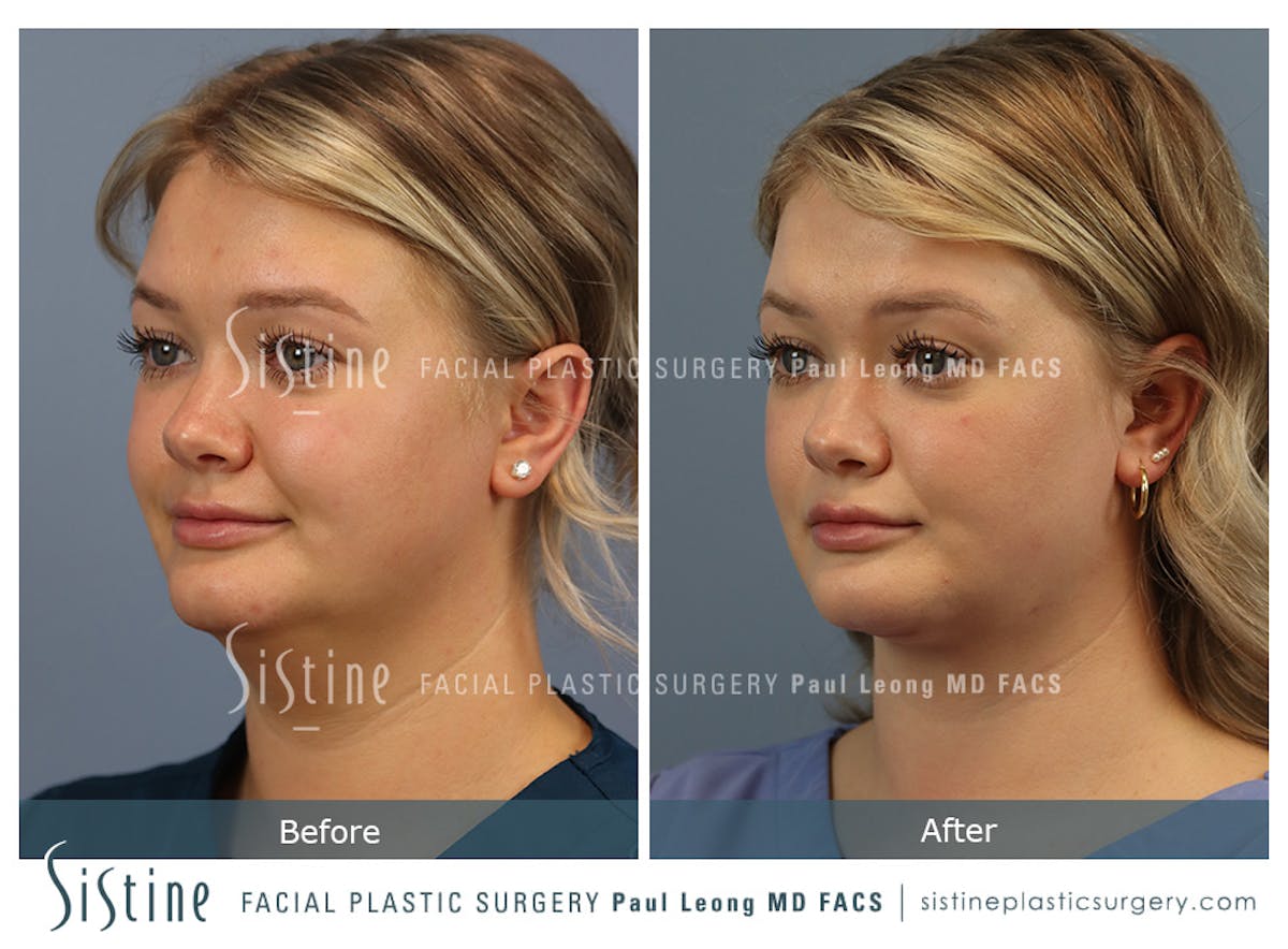 Deep Neck Lift Before & After Gallery - Patient 118546 - Image 5
