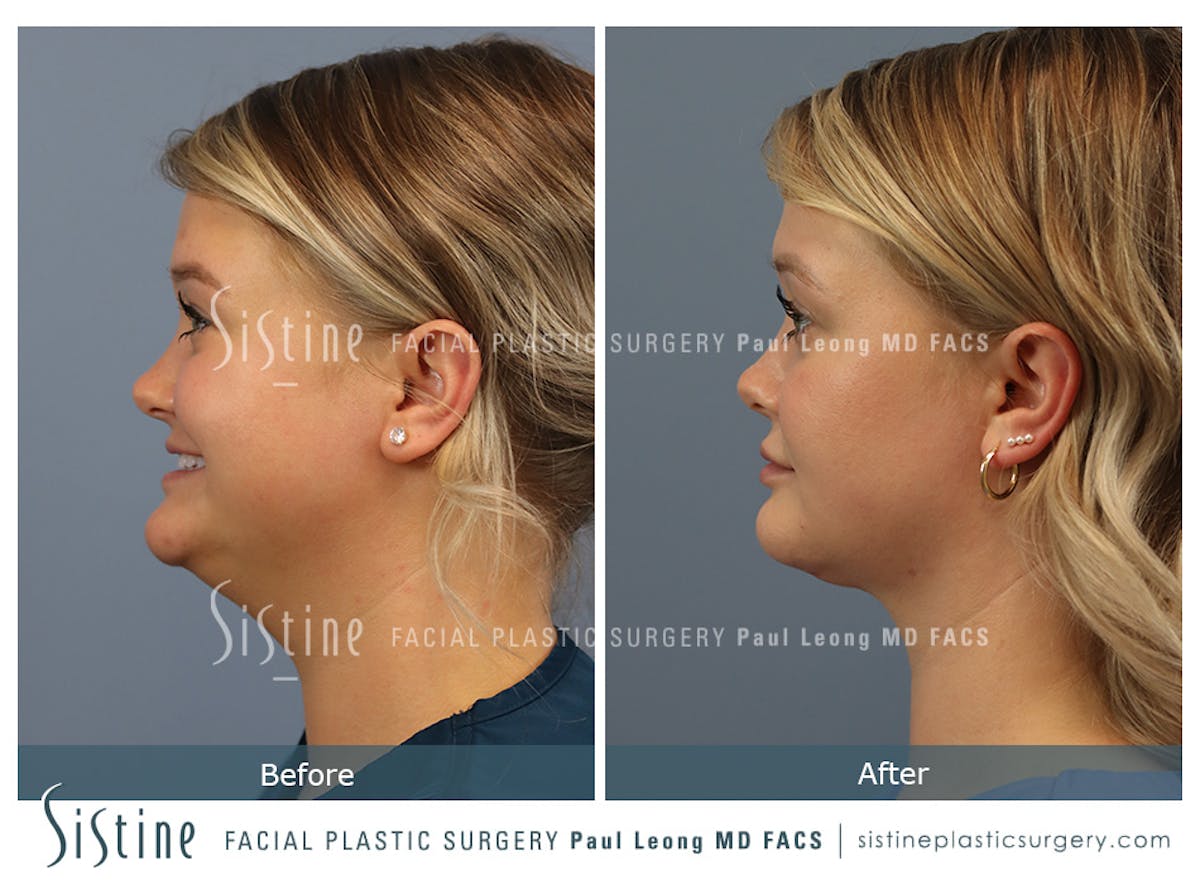 Deep Neck Lift Before & After Gallery - Patient 118546 - Image 6