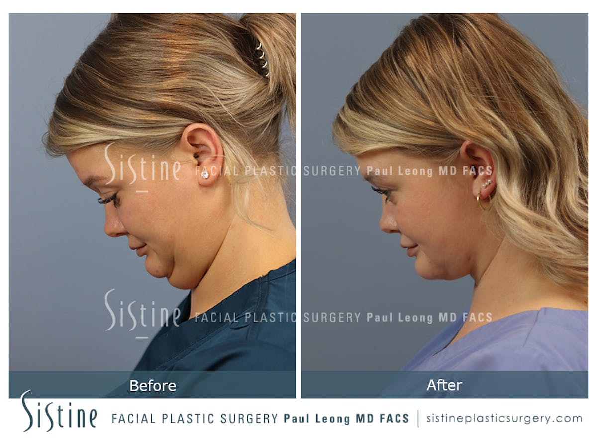 Deep Neck Lift Before & After Gallery - Patient 118546 - Image 7