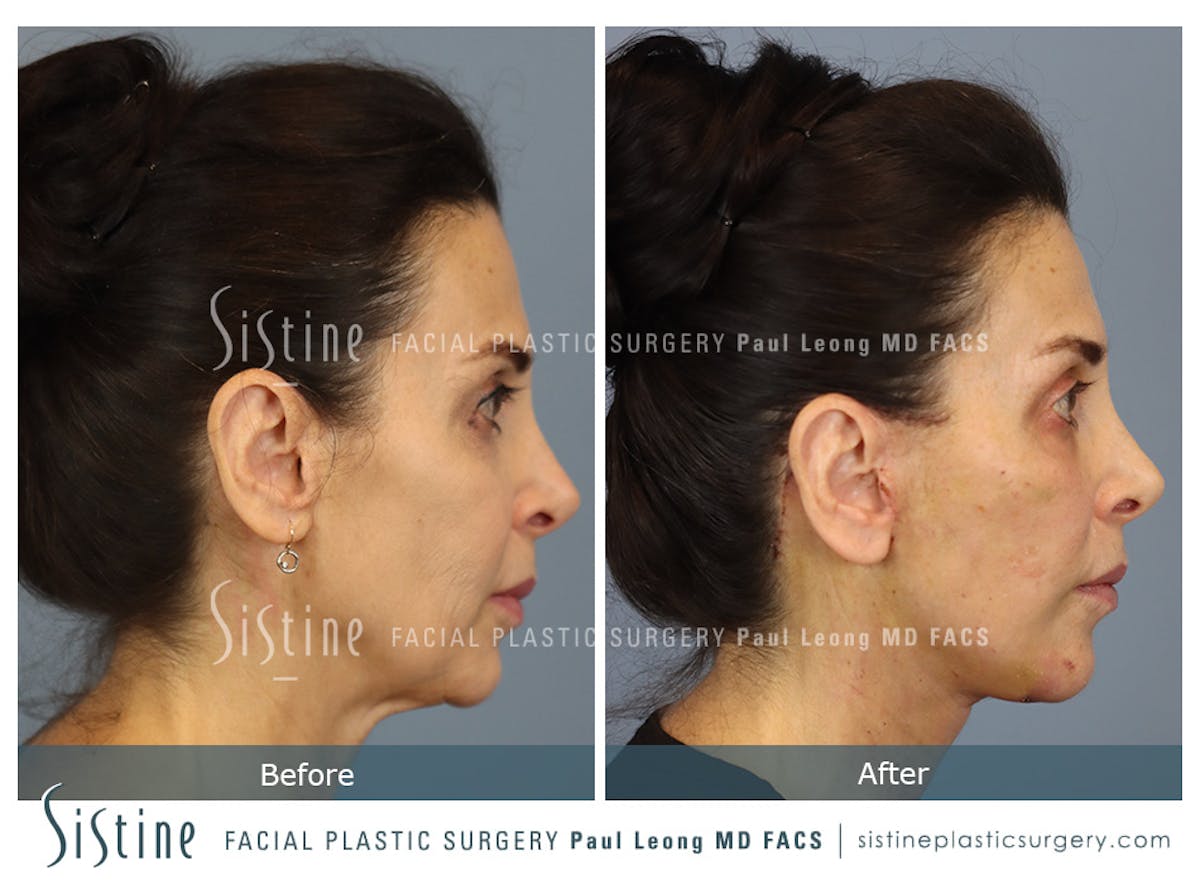 Deep Neck Lift Before & After Gallery - Patient 579785 - Image 1