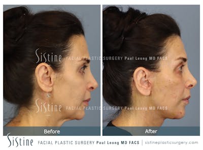 Deep Neck Lift Before & After Gallery - Patient 579785 - Image 1